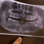 Răng bị chấm đen