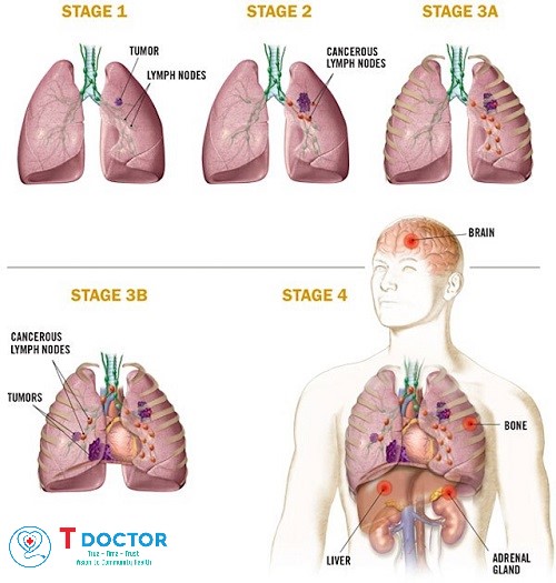 Các giai đoạn của ung thư phổi