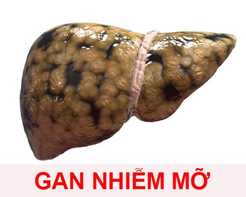 Cần làm gì khi bị gan nhiễm mỡ?