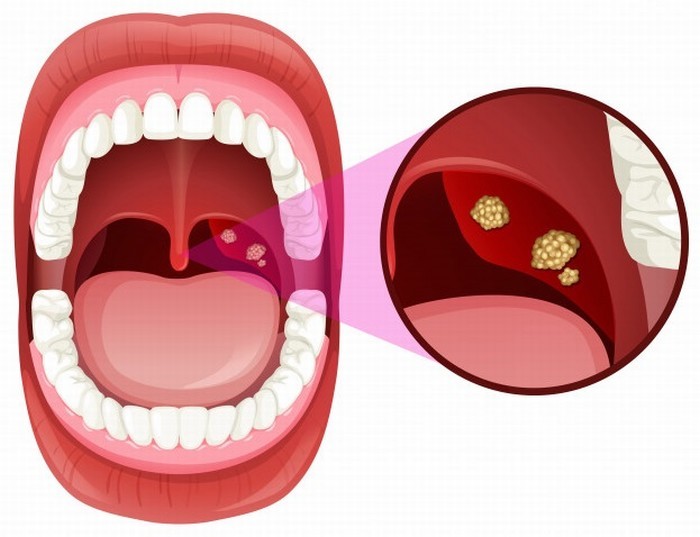 Điều trị viêm amidan tái phát nhiều lần