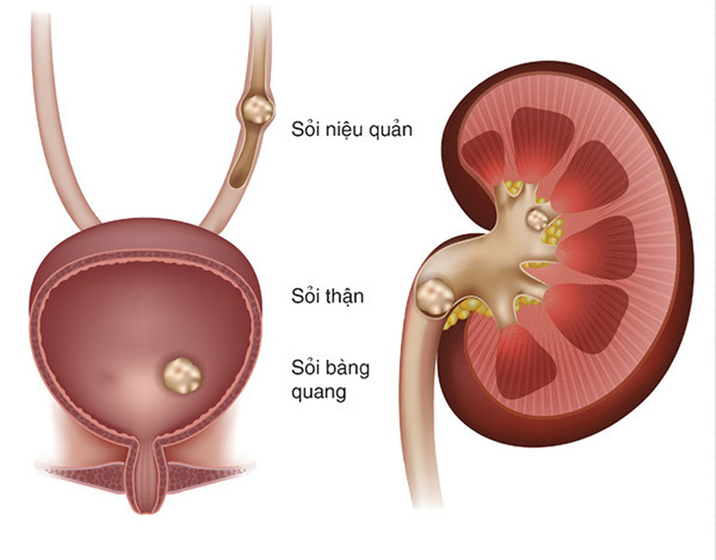   Trường hợp bệnh nhân sỏi thận phải nhập viện khẩn cấp giữa đại dịch COVID-19