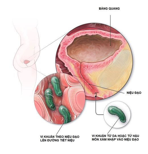 NHIỄM KHUẨN NIỆU/ NHIỄM TRÙNG TIỂU/ VIÊM ĐƯỜNG TIẾT NIỆU