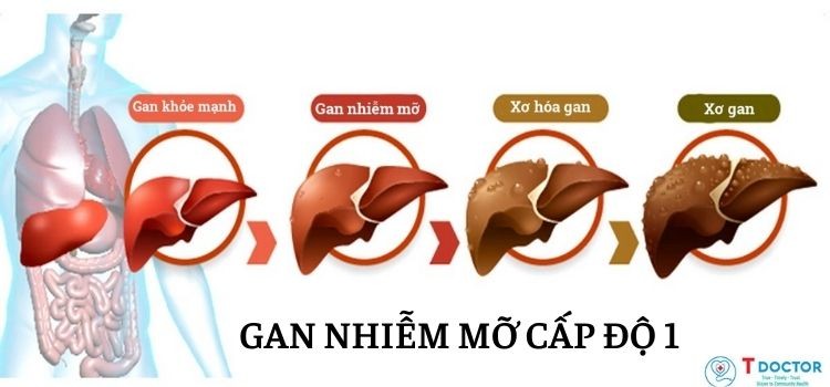 Bệnh gan nhiễm mỡ cấp độ 1 là gì và có nguy hiểm hay không?