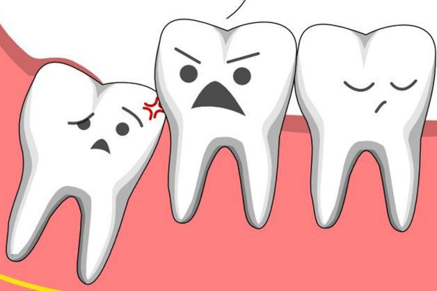 Nhổ răng số 8 có nên tự thực hiện hay cần đến bác sĩ