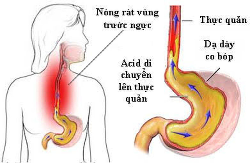  Triệu chứng,điều trị viêm dạ dày trào ngược thực quản. 