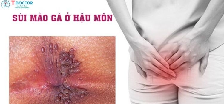 Cách trị sùi mào gà ở hậu môn tại nhà an toàn và hiệu quả