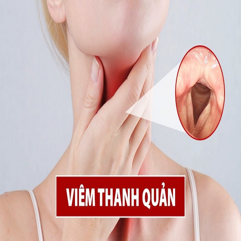      Viêm thanh quản có phải là biểu hiện của Covid 19 không?