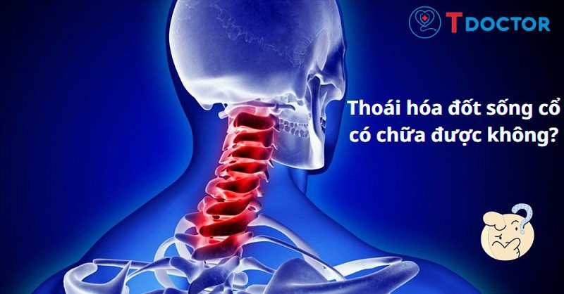 Thoái hóa đốt sống cổ: Nguyên nhân, triệu chứng và cách chữa trị